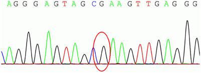 A homozygous PRKN-associated juvenile Parkinson's disease with pregnancy in China